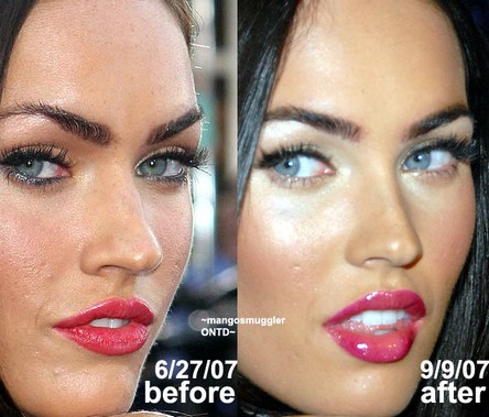 megan fox plastic surgery before and after 2011. million cosmetic surgeries